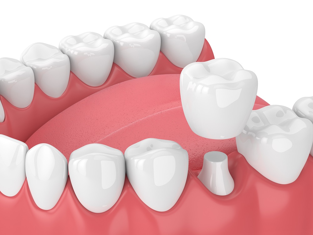 dental crowns in voorhees