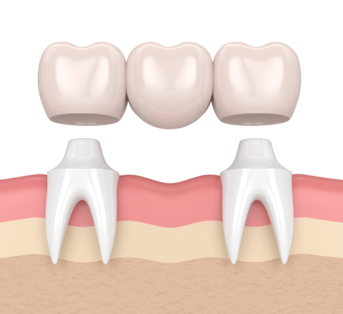 dental bridges in voorhees nj